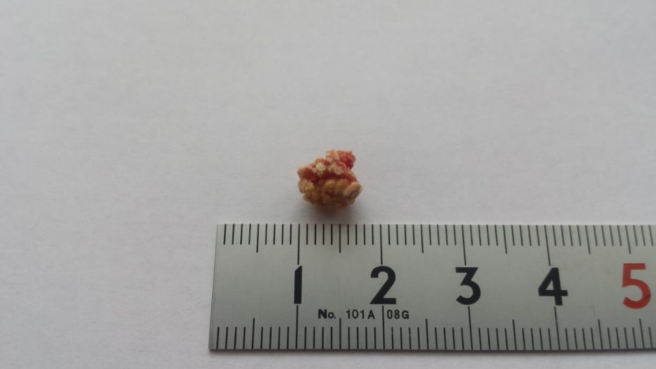 唾石症の体験談!僕の発症から手術までのすべてを紹介します! 唾石症の体験談!僕の発症から手術までのすべてを紹介します!